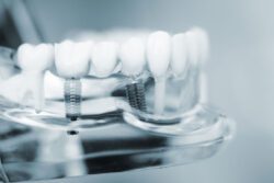 By understanding the causes, consequences, and available treatments for missing teeth, you can make informed decisions about your dental care.